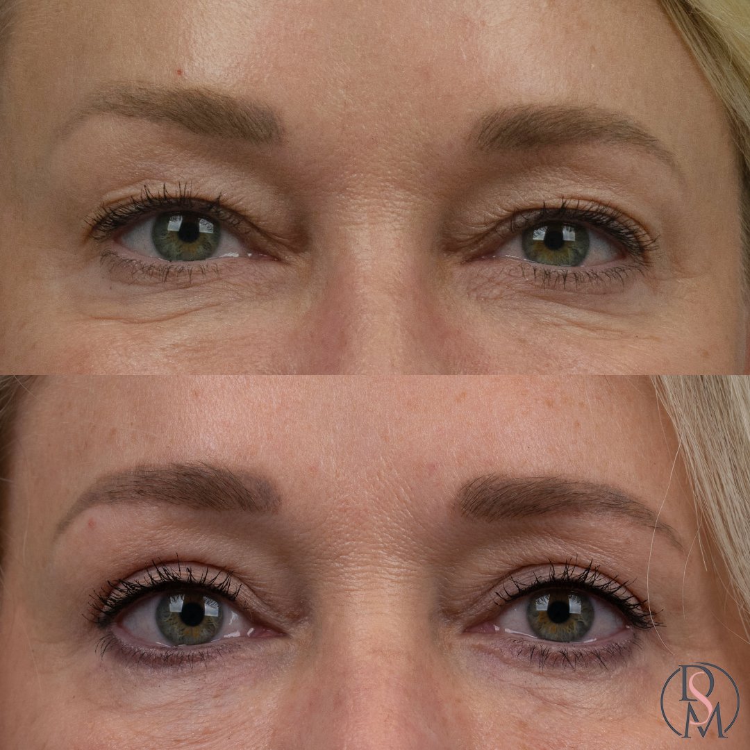 Eyelid Procedure Before and After