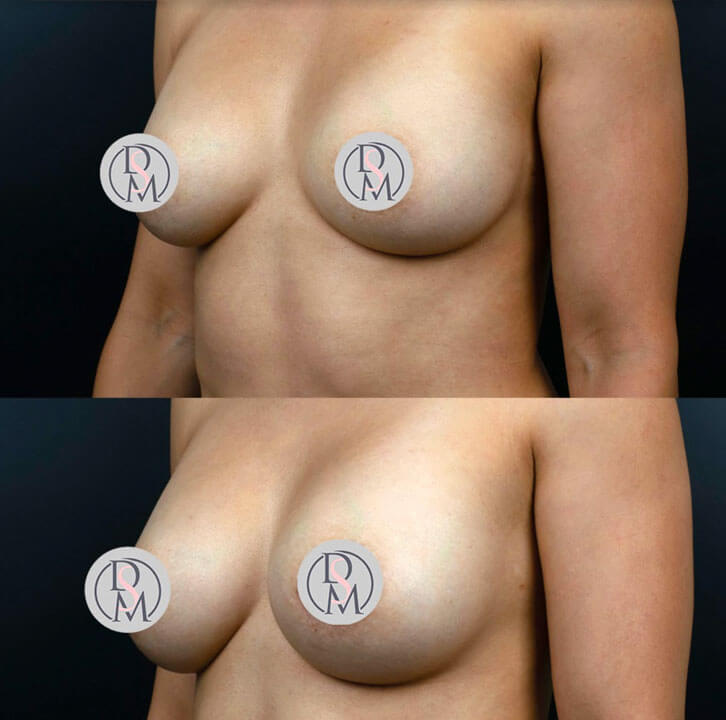 before and after breast revision