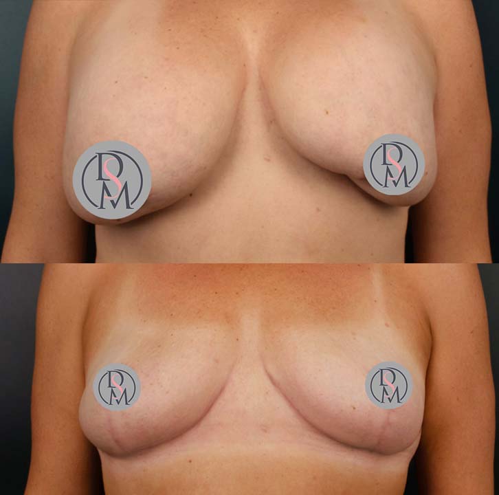 Breast Implant Removal with Bilateral Mastopexy