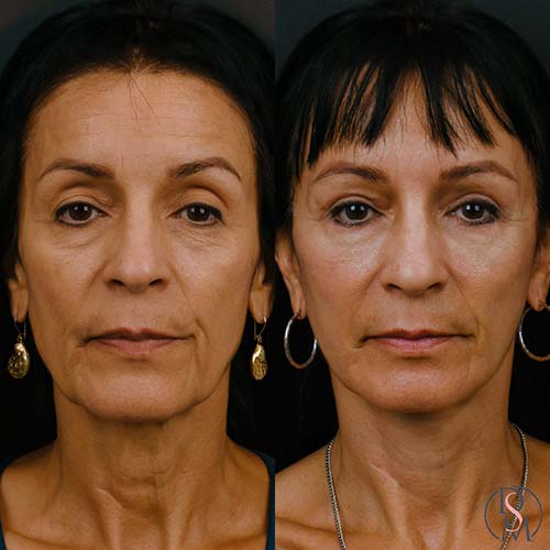 Lower Face & Neck Lift, Brow Lift, Upper & Lower Blepharoplasty, Facial Fat Grafting 