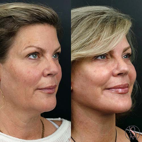 facelift before & after