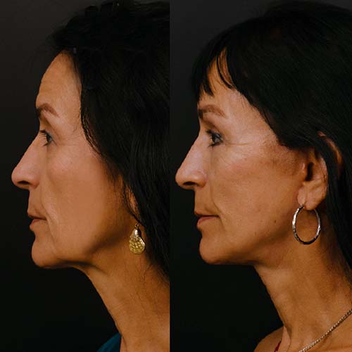 Lower Face & Neck Lift, Brow Lift, Upper & Lower Blepharoplasty, Facial Fat Grafting 