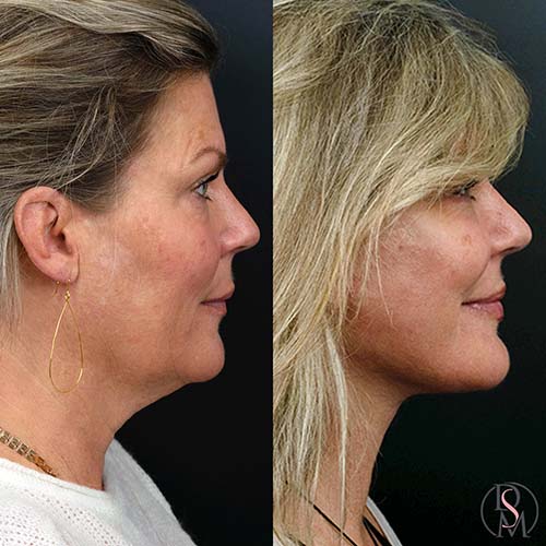 facelift before & after