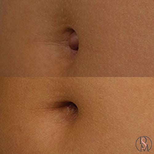 umbilcoplasty before and after