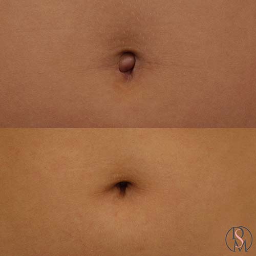 umbilcoplasty belly button before & after