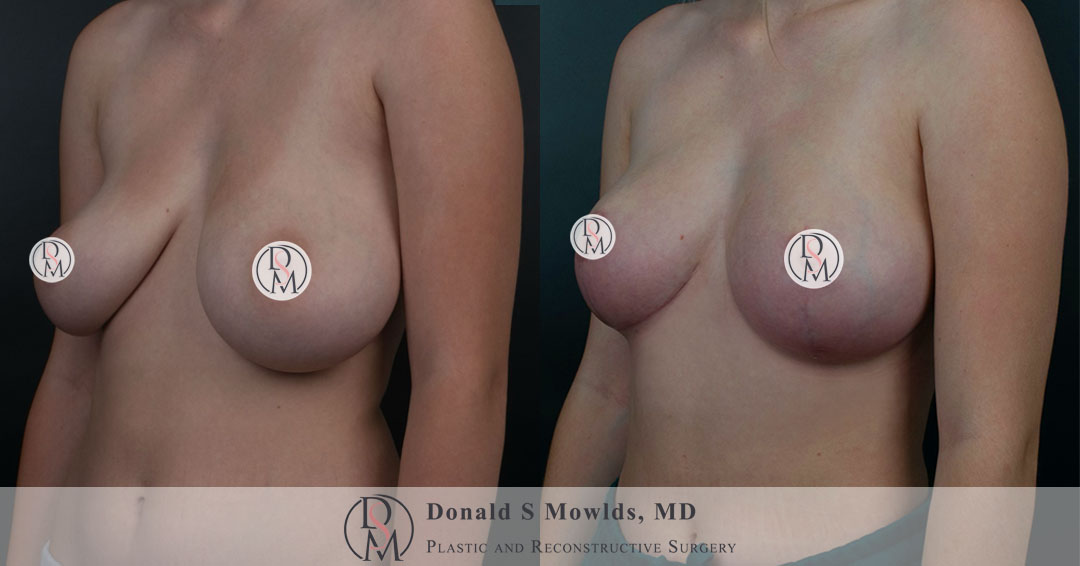 Breast lift (Mastopexy) with fat grafting