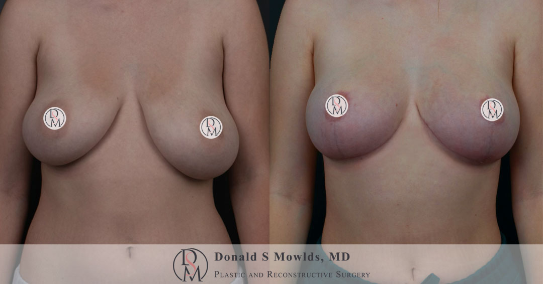 Breast lift (Mastopexy) with fat grafting
