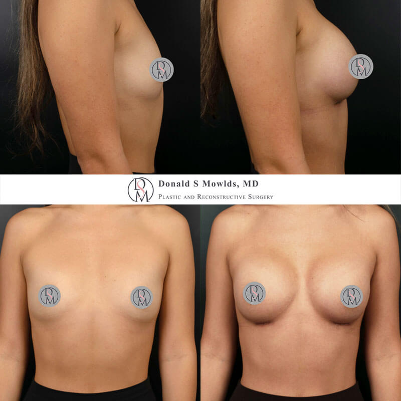 Bilateral Breast Augmentation Silicone Implants 250cc