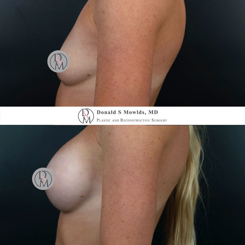 Breast augmentation 375cc silicone implants