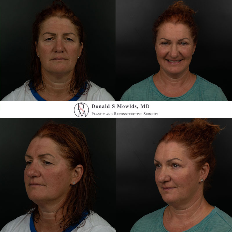 Endoscopic brow lift, upper and lower blepharoplasty (eyelid surgery), fat transfer to lower eyelids