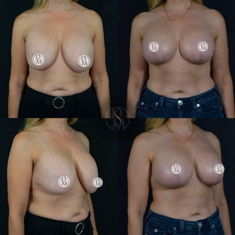 before and after breast revision